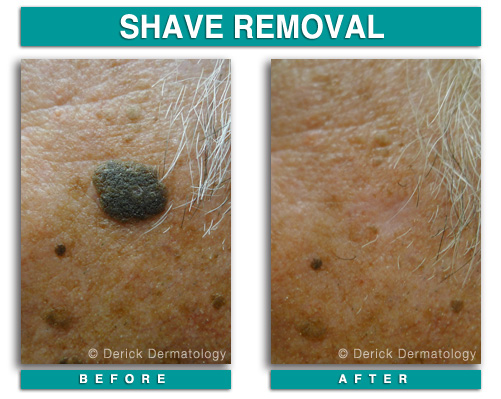 Shave Removal of Seborrheic Keratosis