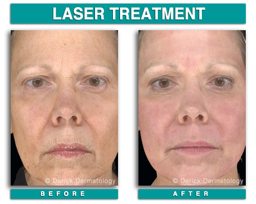 Dermatology Before and After | Botox, Latisse, CoolSculpting