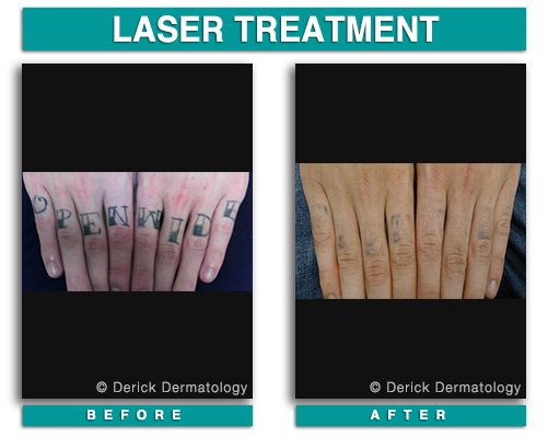 Dermatology Before and After | Botox, Latisse, CoolSculpting