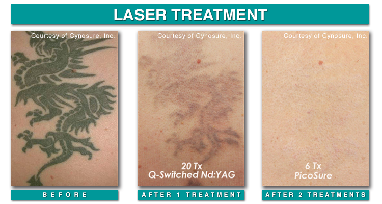 tattoo removal q switched laser