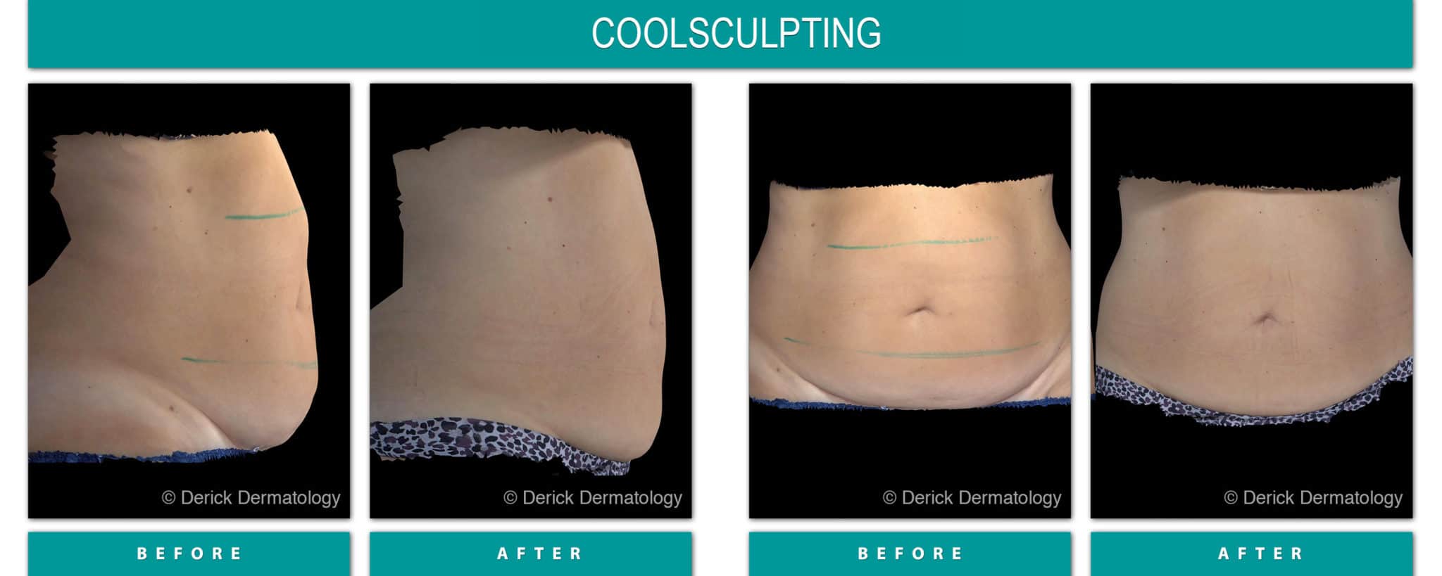 Before and After Image of Coolsculpting