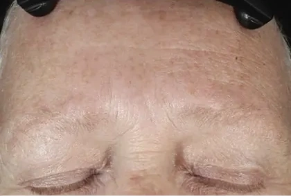 DiamondGlow skin after treatment