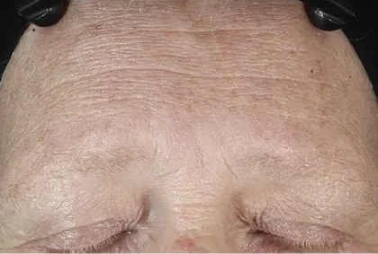 DiamondGlow skin before treatment