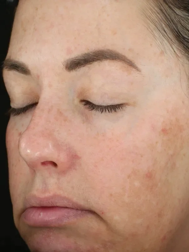 DiamondGlow skin after treatment