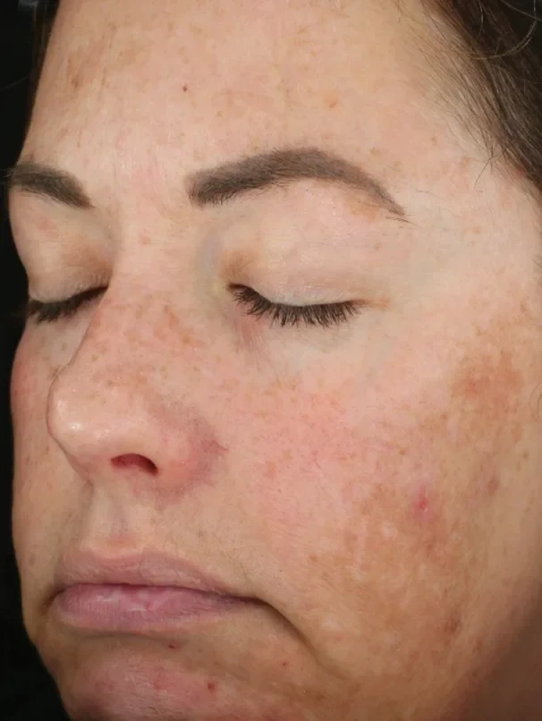 DiamondGlow skin before treatment