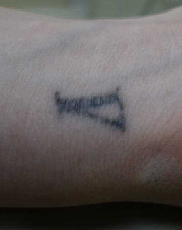 Tattoo Removal Process