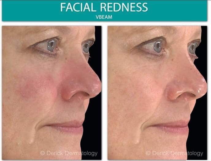 before and after of woman’s redness on cheek with vbeam