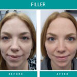 Before and After Image of Filler