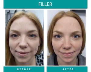 Before and After Image of Filler