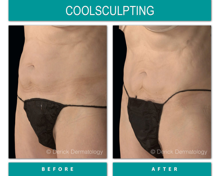 coolsculpting before and after of stomach fat