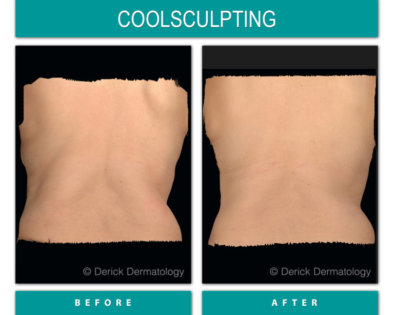 coolsculpting before and after of back fat