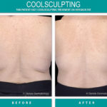 coolsculpting before and after of back fat