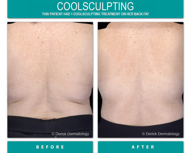 Coolsculpting coolsculpting before and after of back fat