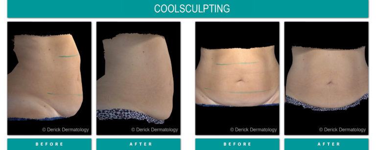 coolsculpting before and after side and front view of stomach fat