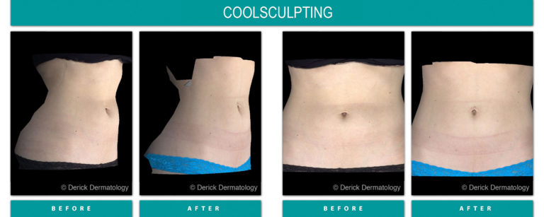 derick dermatology, coolsculpting, before and after pictures of stomach