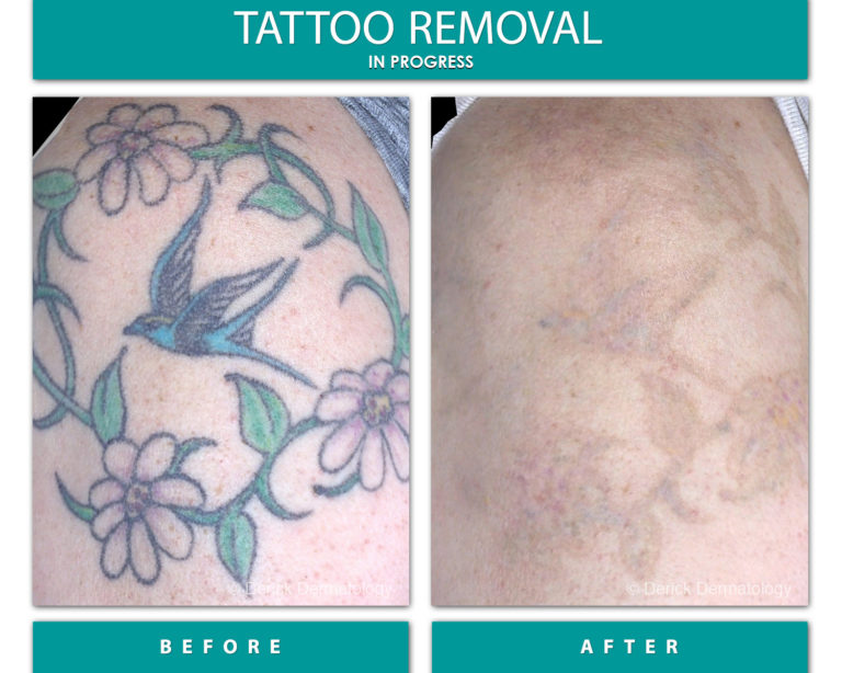 bird and flower tattoo before removal. after picture, faded tattoo