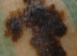 Melanoma
