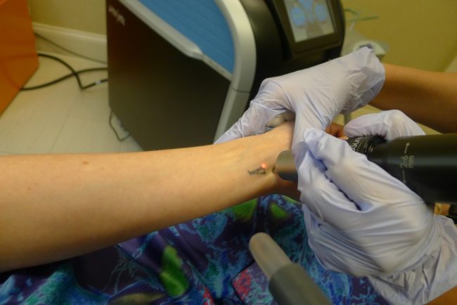 Tattoo Removal Laser Process Tattoo Removal Laser Process