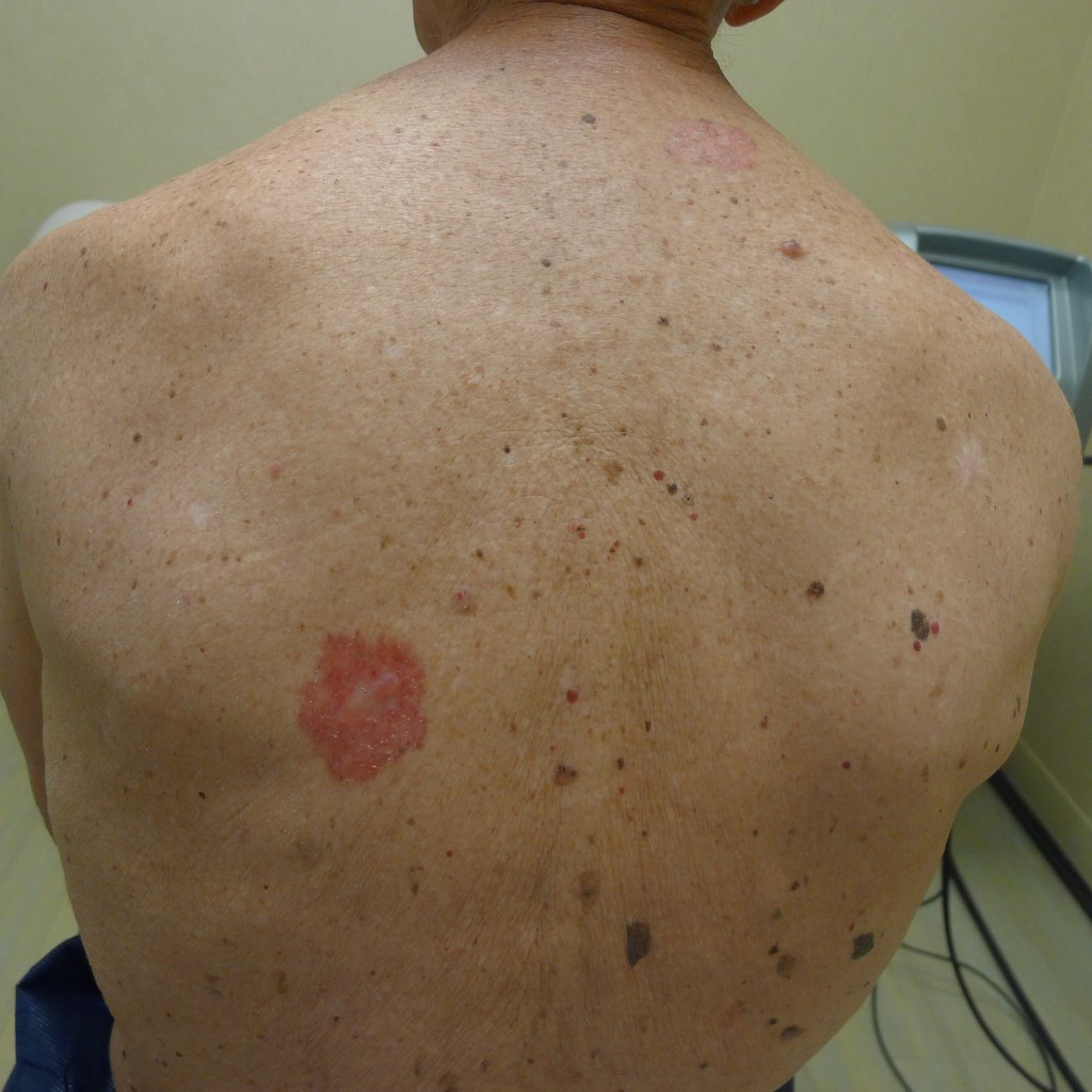 Skin Cancer Symptoms Pictures Photos Types Signs Melanoma