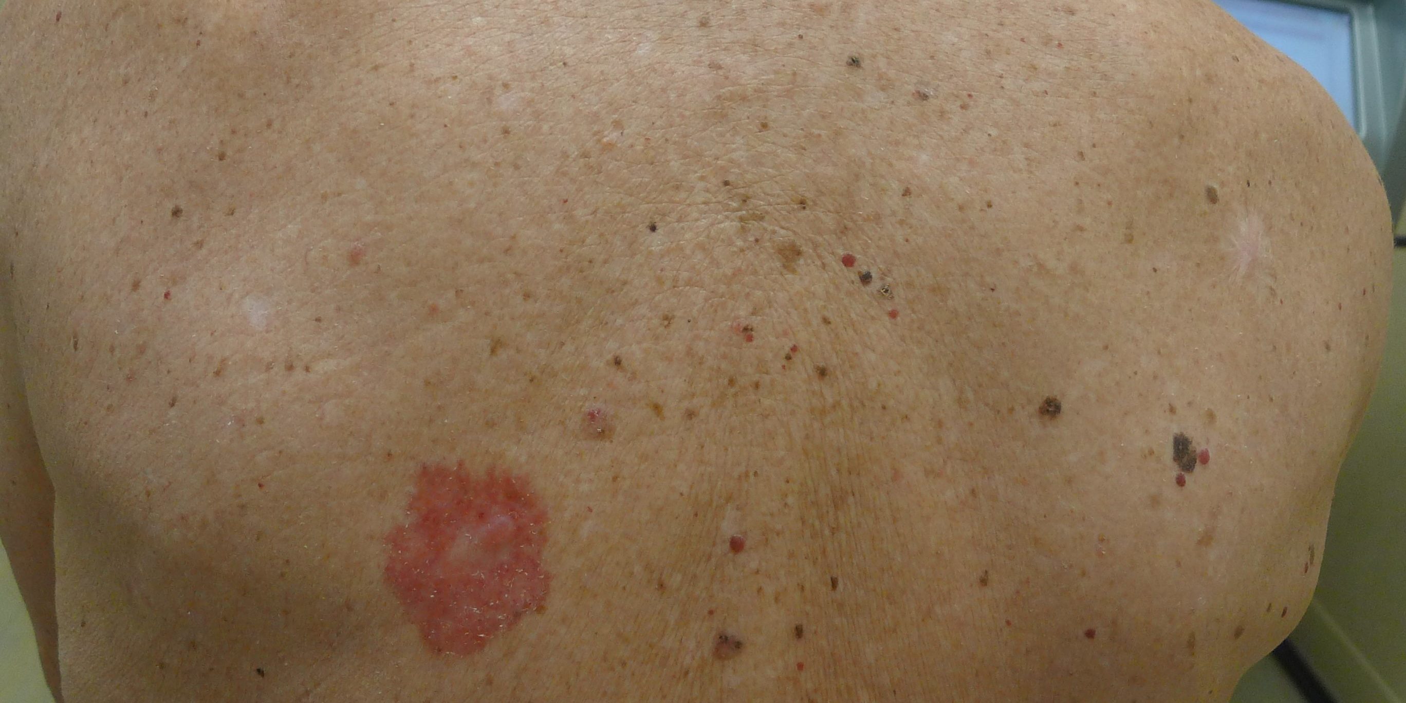 Skin Cancer On Back  2736x1368 