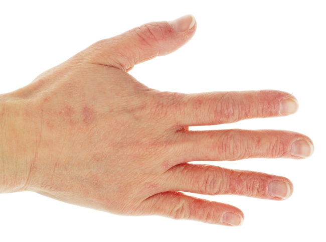 hand dermatitis hand dermatitis