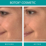 Before and After Image of Botox Cosmetic