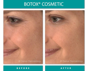 Before and After Image of Botox Cosmetic