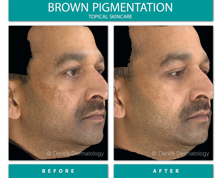 Before and After Image of Brown Pigmentation