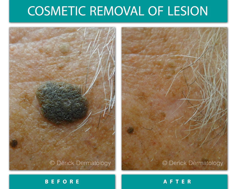 Before and After Image of Cosmetic Removal of Lesion