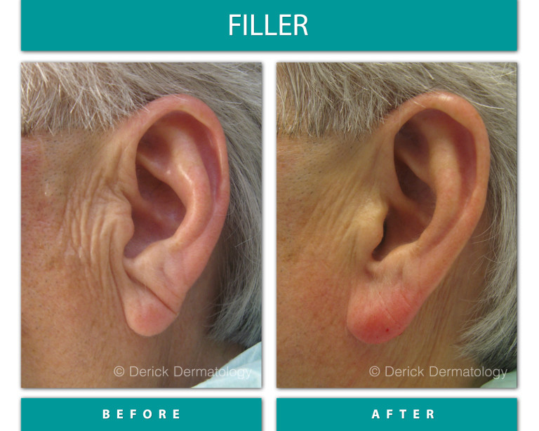Before and After Image of Filler