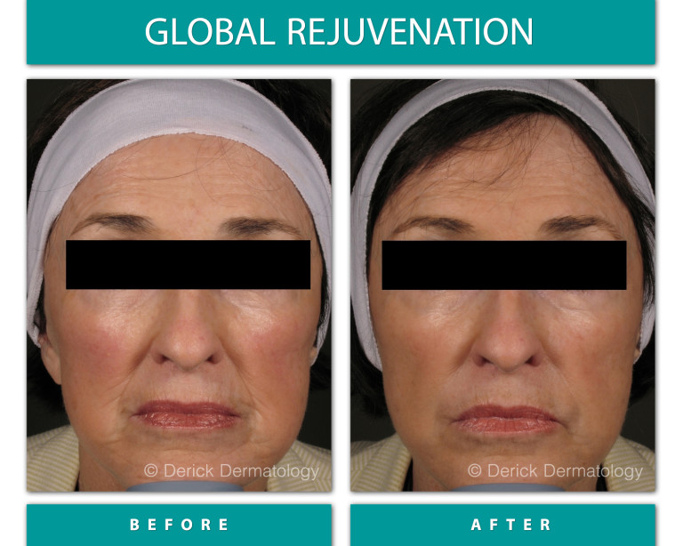 Before and After Image of Global Rejuvenation