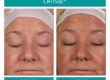 Before and After Image of Latisse