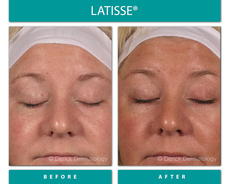 Before and After Image of Latisse