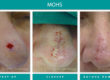 Before and After Image of Mohs Surgery