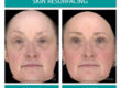 Before and After Image of Skin Resurfacing