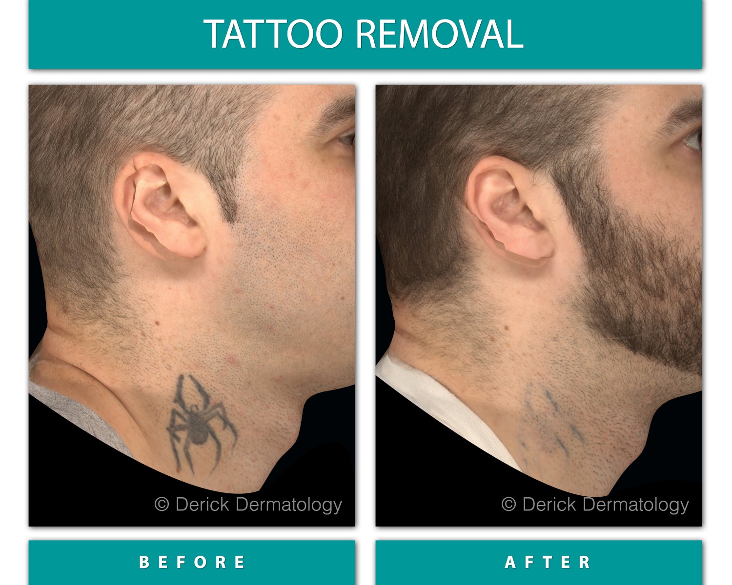 Laser Tattoo Removal The Cosmetic Week 3 Post 1st 