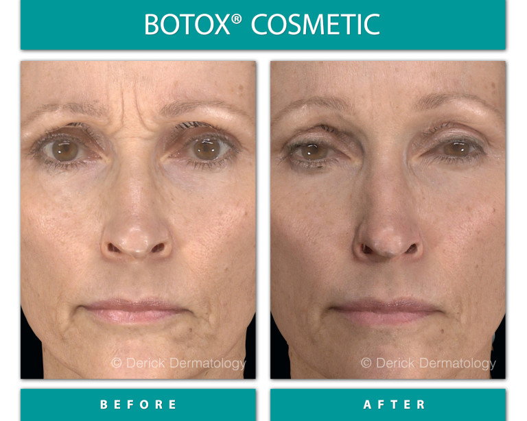 Before & After Gallery - Botox® - Derick Dermatology