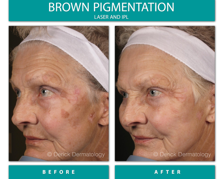 Before and After Image of Brown Pigmentation