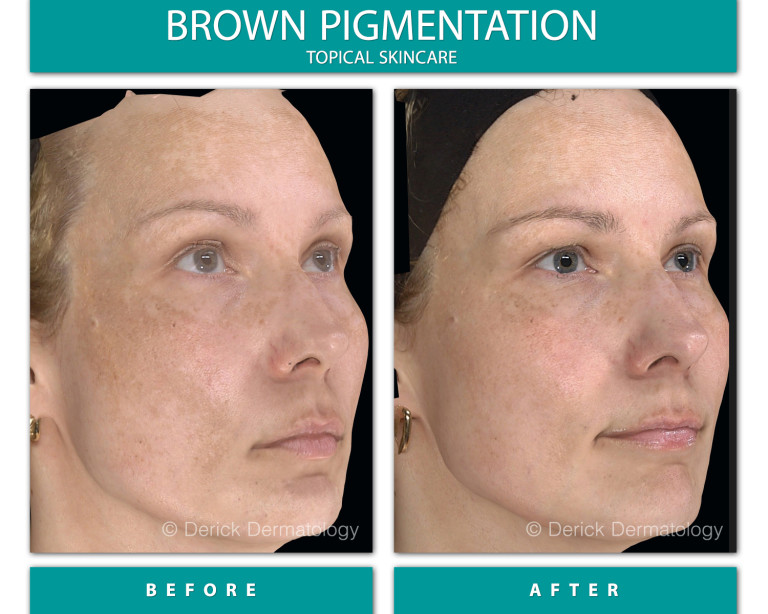 Before and After Image of Brown Pigmentation
