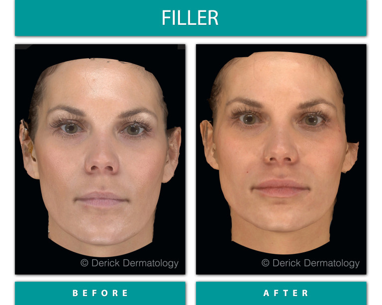 Before and After Image of Filler