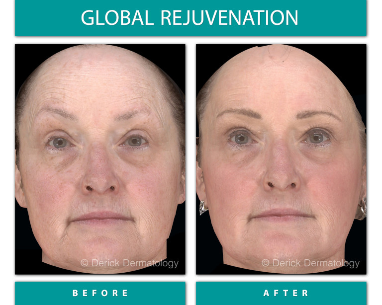 Before and After Image of Global Rejuvenation