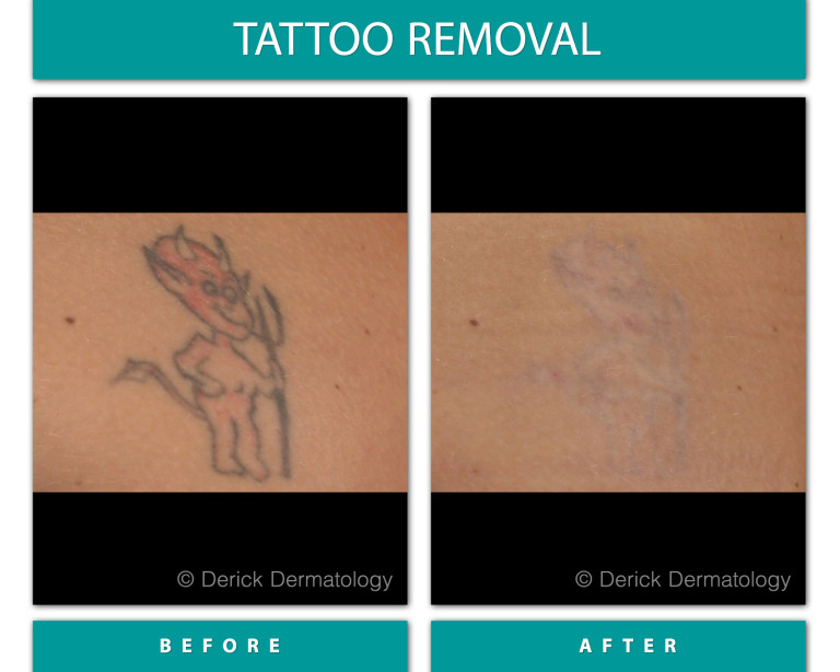 Before and After Image of Tattoo Removal