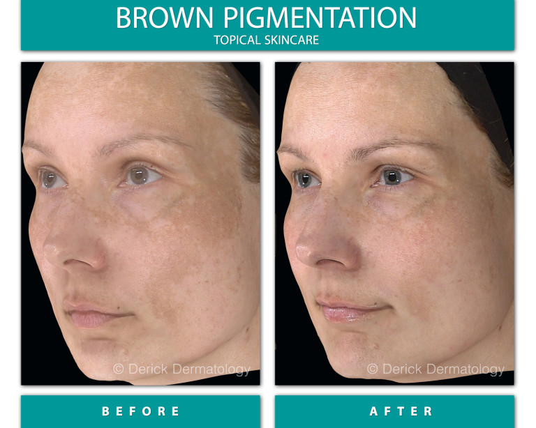 Before and After Image of Brown Pigmentation
