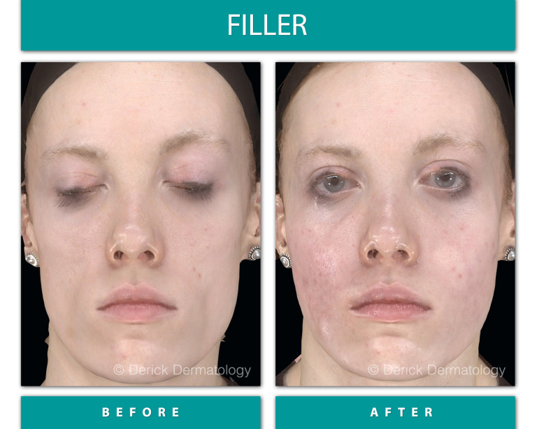Before and After Image of Filler