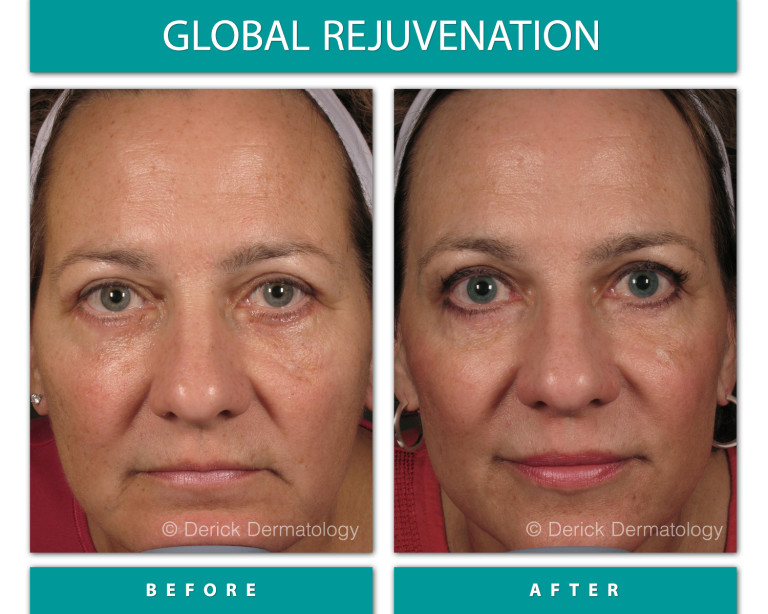 Before and After Image of Global Rejuvenation