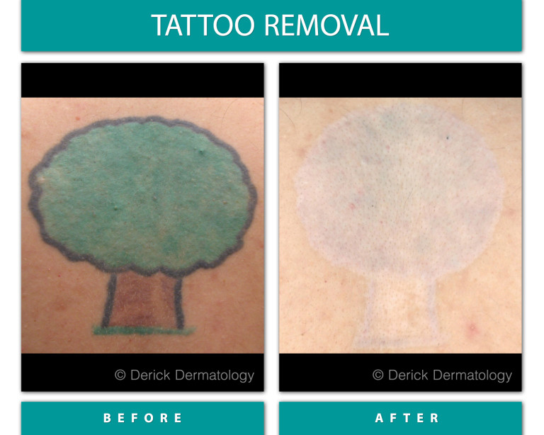 Before and After Image of Tattoo Removal