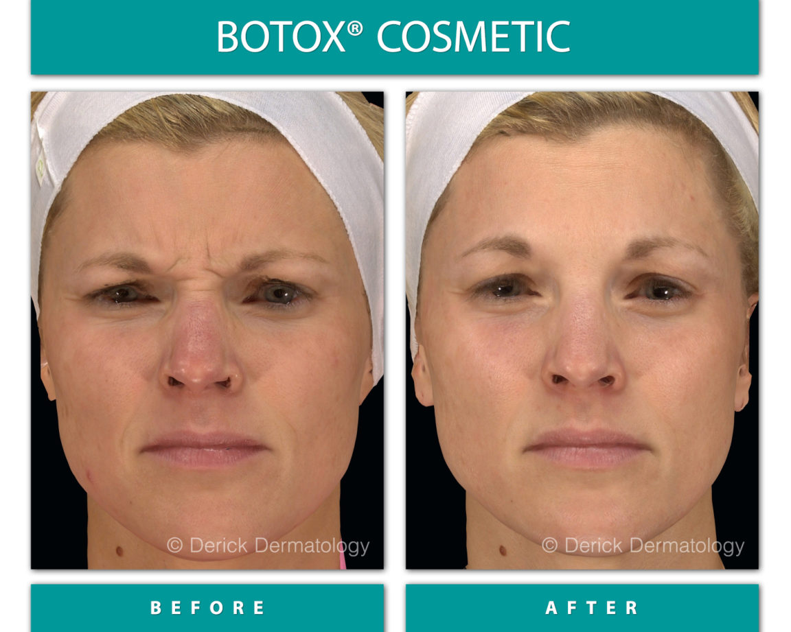 Before After Gallery Botox® Derick Dermatology