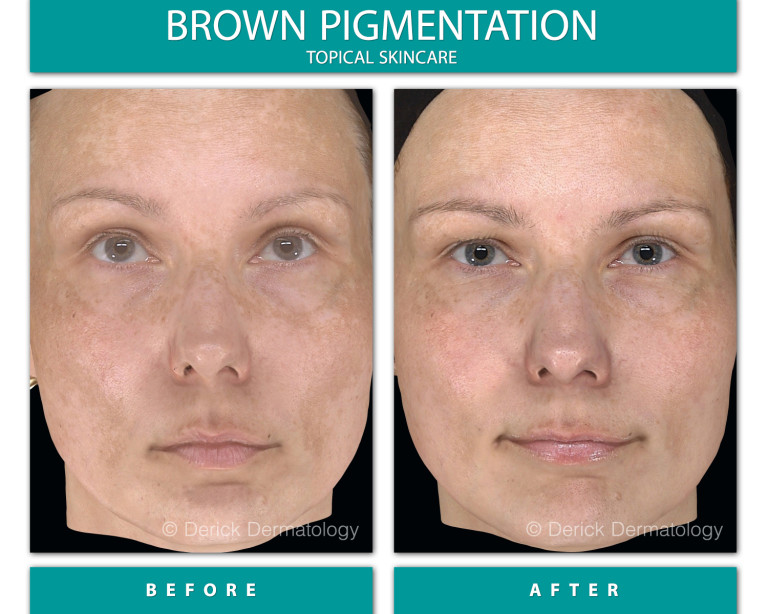 Before and After Image of Brown Pigmentation