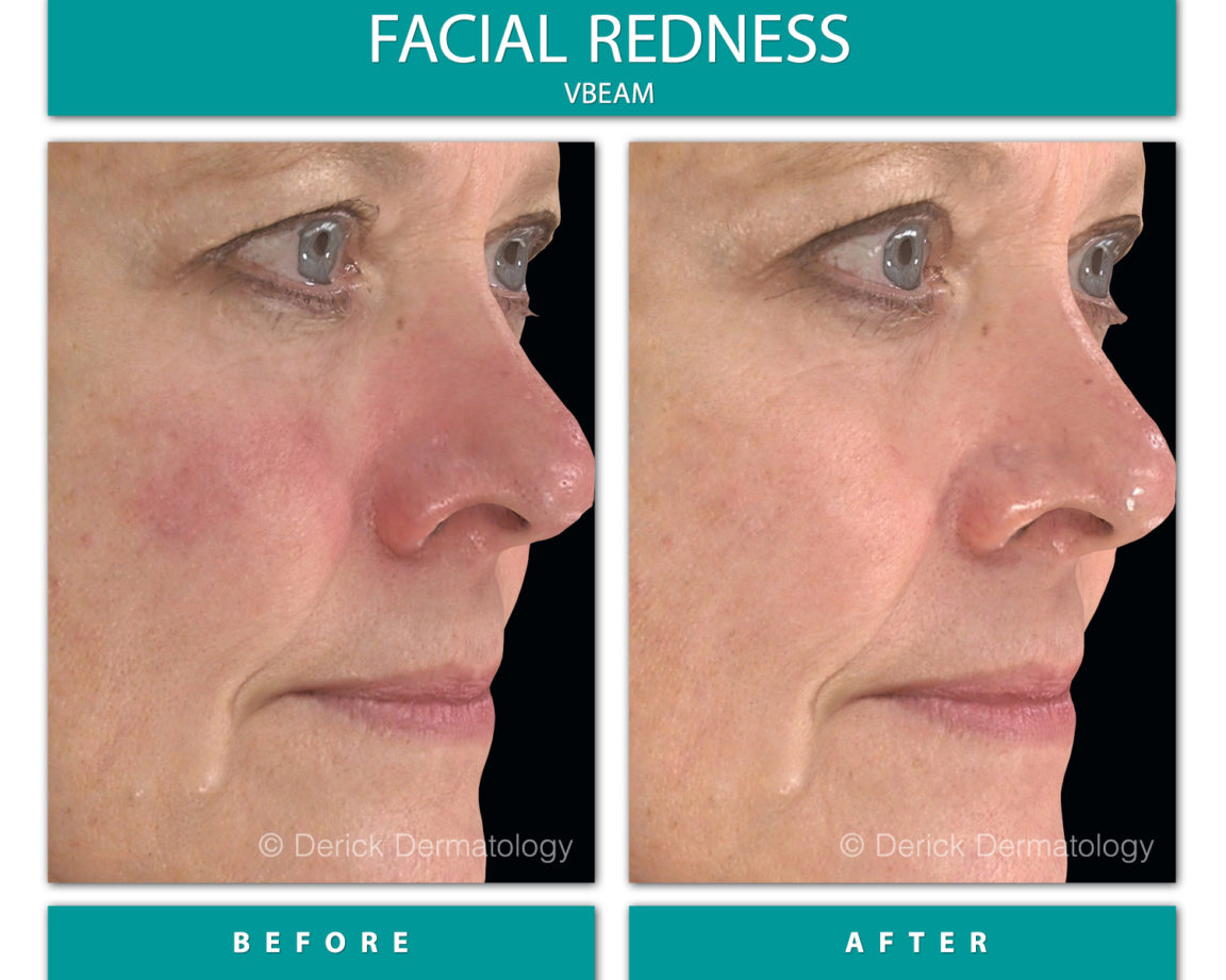 Before & After Gallery - Facial Redness - VBeam - Derick ...