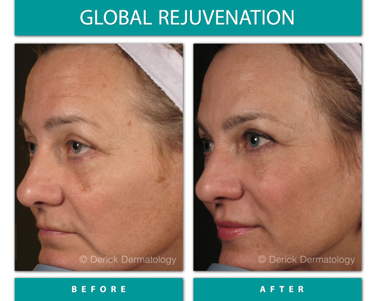 Before and After Image of Global Rejuvenation